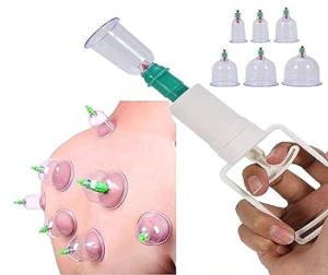 الحجامة الطبيبه الاسلامية لامتصاص السموم 01012187661